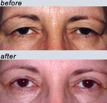 eyelid surgery 5.jpg